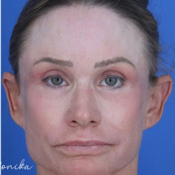 Chemical Peel Before & After Patient #2185