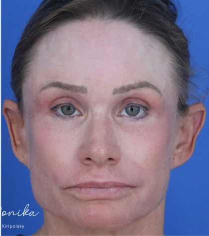 Chemical Peel Before & After Patient #2185