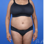 GLP-1 Injections Before & After Patient #2184