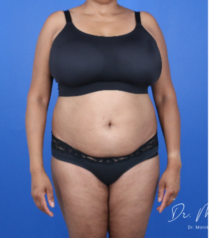 GLP-1 Injections Before & After Patient #2184
