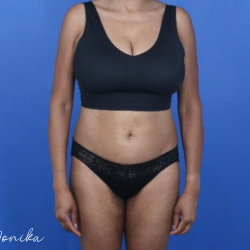 GLP-1 Injections Before & After Patient #2184
