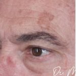 Sunspots Before & After Patient #2204