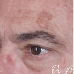 Sunspots Before & After Patient #2204