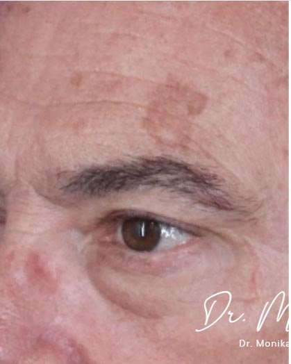Sunspots Before & After Patient #2204