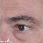 Sunspots Before & After Patient #2204