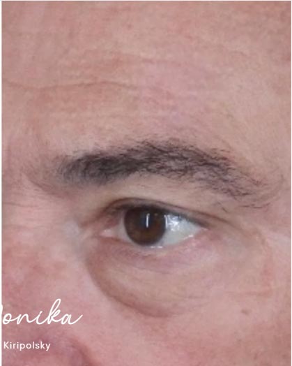 Sunspots Before & After Patient #2204