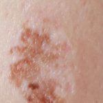 Mole & Melanoma Removal Before & After Patient #2212