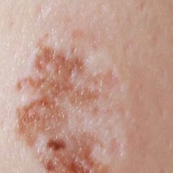 Mole & Melanoma Removal Before & After Patient #2212
