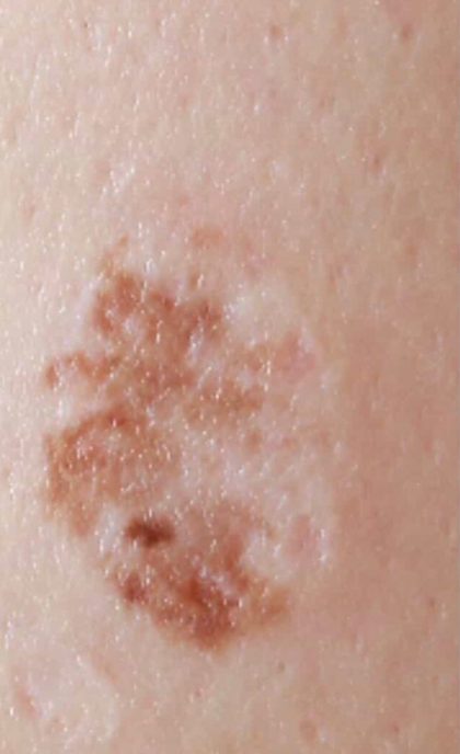 Mole & Melanoma Removal Before & After Patient #2212
