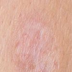 Mole & Melanoma Removal Before & After Patient #2212