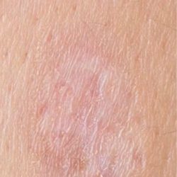 Mole & Melanoma Removal Before & After Patient #2212