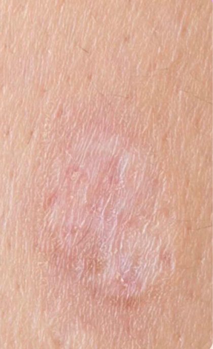 Mole & Melanoma Removal Before & After Patient #2212