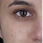 Acne Scarring Before & After Patient #2226