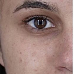 Acne Scarring Before & After Patient #2226