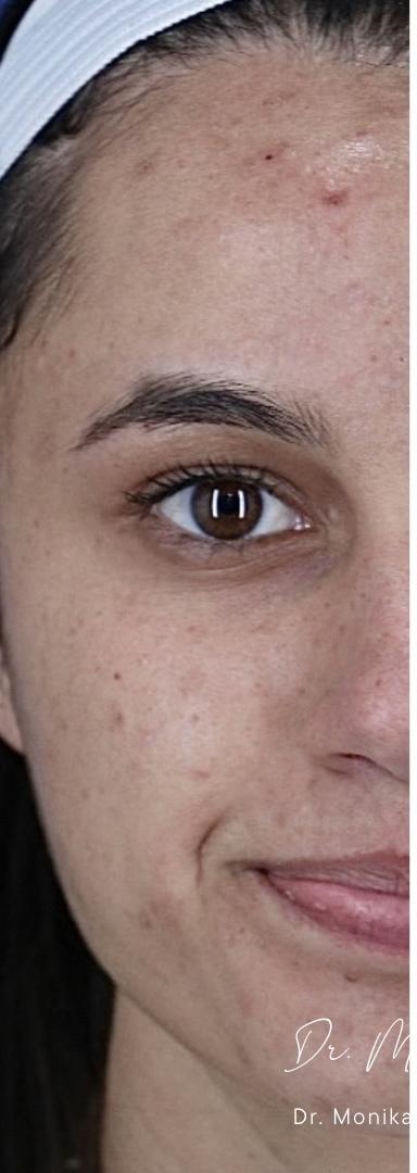 Acne Scarring Before & After Patient #2226