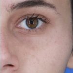 Acne Scarring Before & After Patient #2226