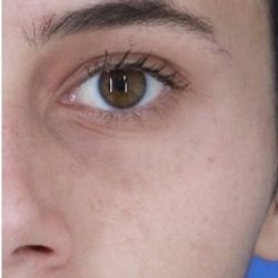 Acne Scarring Before & After Patient #2226