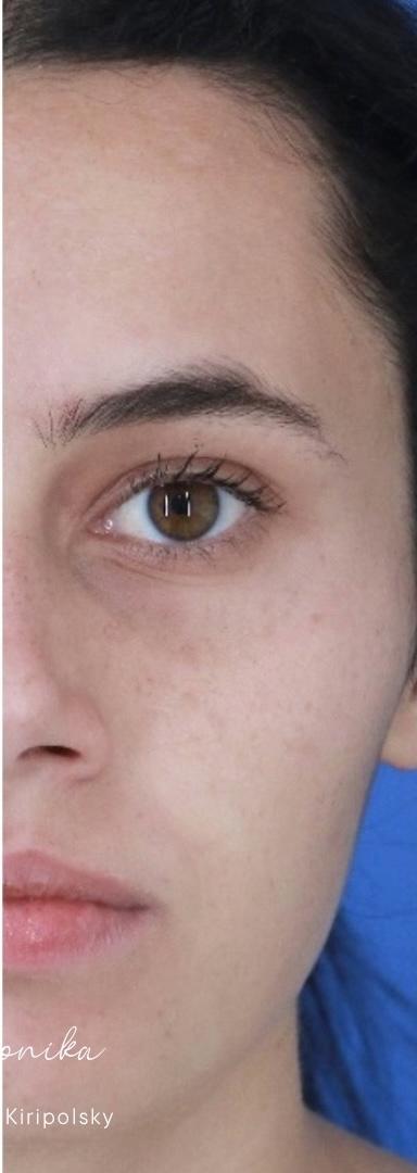 Acne Scarring Before & After Patient #2226