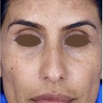 Chemical Peel Before & After Patient #2229