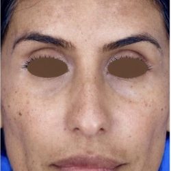 Chemical Peel Before & After Patient #2229