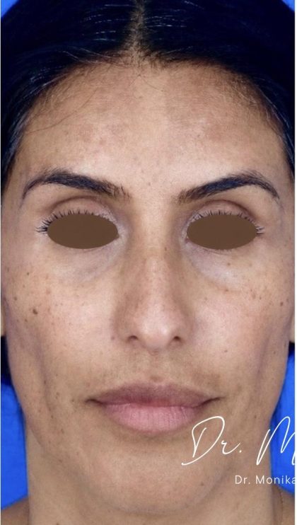 Chemical Peel Before & After Patient #2229