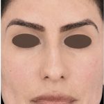 Chemical Peel Before & After Patient #2229
