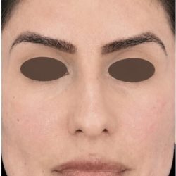Chemical Peel Before & After Patient #2229