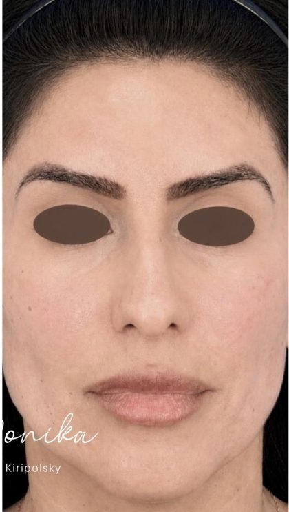 Chemical Peel Before & After Patient #2229
