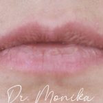 Filler Before & After Patient #2239