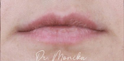 Filler Before & After Patient #2239