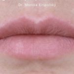 Filler Before & After Patient #2239