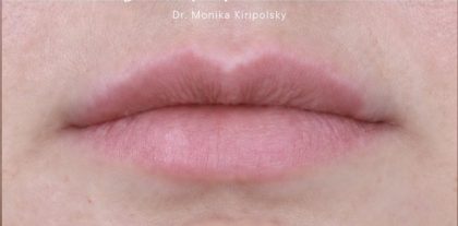 Filler Before & After Patient #2239