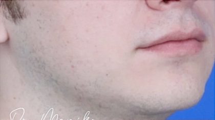 Filler Before & After Patient #2239