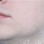 Filler Before & After Patient #2239