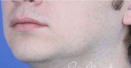 Filler Before & After Patient #2239