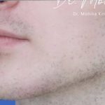 Filler Before & After Patient #2239