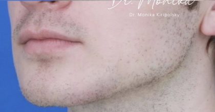 Filler Before & After Patient #2239